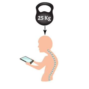 Improper posture symptoms. Text Neck Syndrome. Spinal curvature, kyphosis Stock Illustration