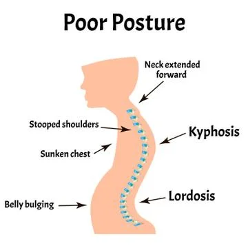 Improper posture symptoms. Text Neck Syndrome. Spinal curvature, kyphosis Stock Illustration