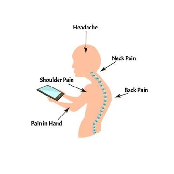 Improper posture symptoms. Text Neck Syndrome. Spinal curvature, kyphosis Stock Illustration