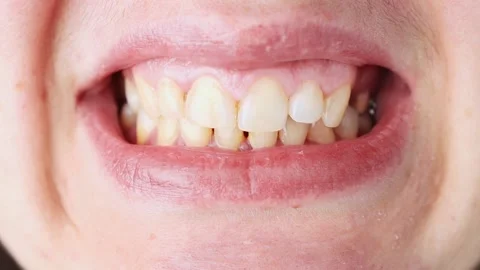 Incorrect closure of the jaw in a person close-up. Stock Footage 170476316