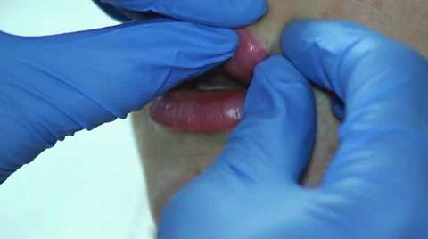 Increase Lip Volume Stock Footage 65990881