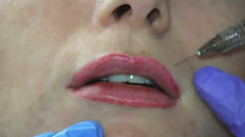 Increase Lips Hyaluronic Acid Stock Footage 65990773