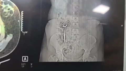 India: Doctors left baffled after CT scan reveals pair of scissors in wom... Vídeos de archivo 294057244