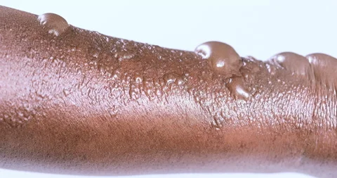 Indian arm 2nd Degree Burns Blisters in a close up shot Stock Footage 248626302