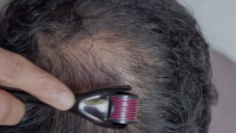 Indian man using derma roller on head to treat hairloss. Stock Footage 303326260