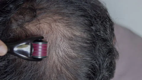 Indian man using derma roller on his alopecia head. Stock Footage 303327008