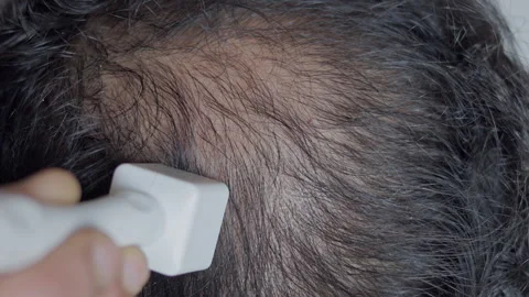 Indian man using derma stamp on his alopecia head. Видео 303327211