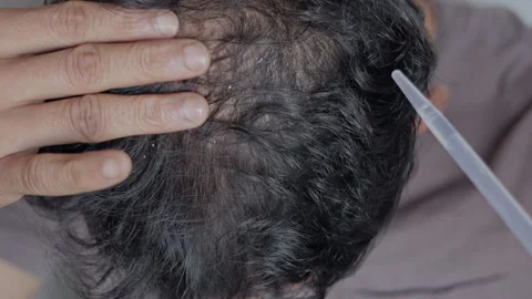 Indian man using minoxidil on his bald patches. 库存影片 303327048