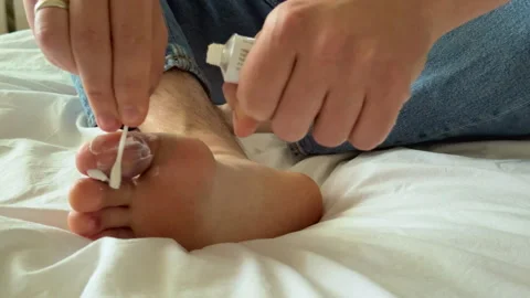 Individual applying topical cream to a toe with a visible hematoma while seated 스톡 동영상 333654066