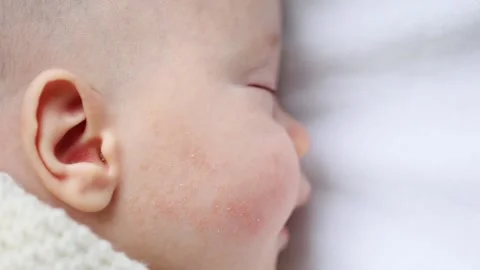 Dermatitis Baby Stock Videos – Royalty-Free HD & 4K Videos | Pond5