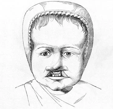 Infant with cleft palate and cleft lip. 19th Century. Stock Illustration