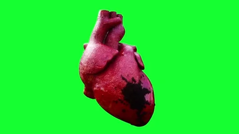 Infarct, heart contraction, green screen 4k animation. Stock Footage 301330616