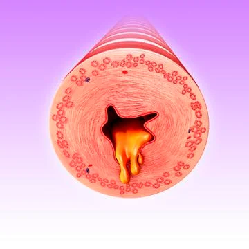 Infected bronchus, illustration Stock Illustration