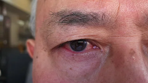 Infected eye. Stock Footage 172481142