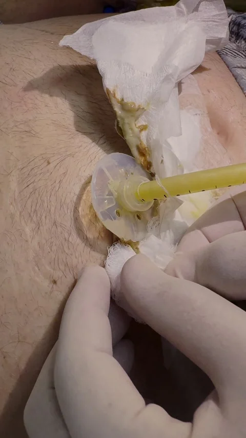 Infection at the gastrostomy insertion Stock Footage 312117347