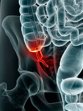 Inflamed appendix, artwork Stock Illustration