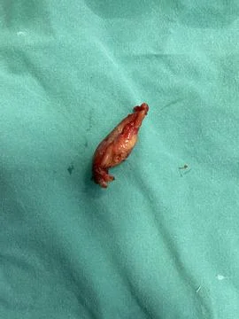 Inflamed Appendix Surgically Removed Stock Photos