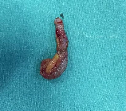 Inflamed Appendix Surgically Removed Stock Photos