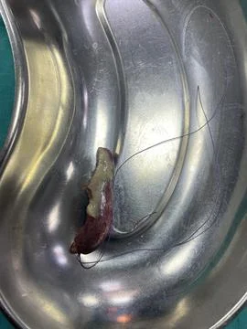 Inflamed Appendix Surgically Removed 库存照片