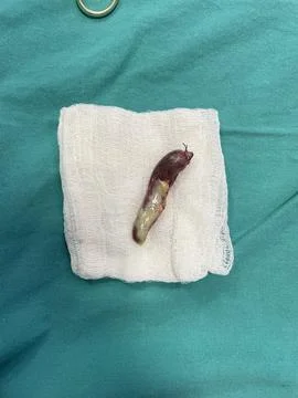 Inflamed Appendix Surgically Removed Stock Photos