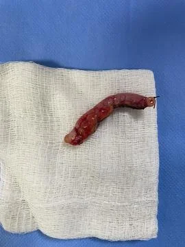 Inflamed Appendix Surgically Removed 库存照片