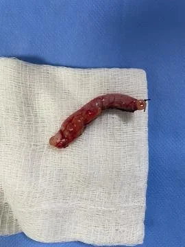 Inflamed Appendix Surgically Removed Stock Photos