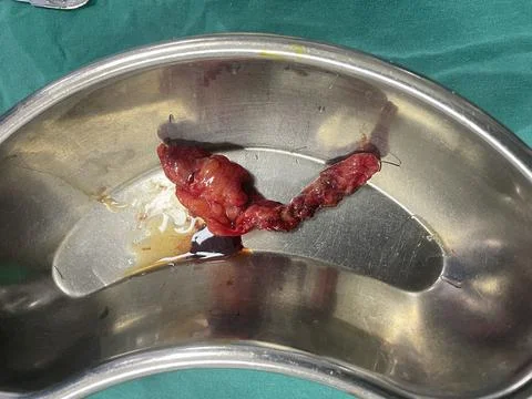 Inflamed Appendix Surgically Removed Stock Photos