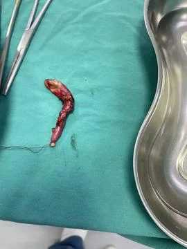 Inflamed Appendix Surgically Removed Stock Photos