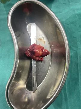 Inflamed Appendix Surgically Removed Stock Photos