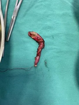 Inflamed Appendix Surgically Removed Stock Photos