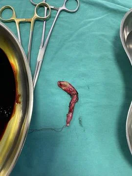 Inflamed Appendix Surgically Removed Foto stock