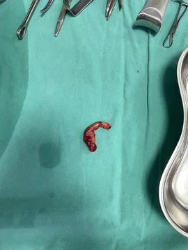 Inflamed Appendix Surgically Removed Stock Photos