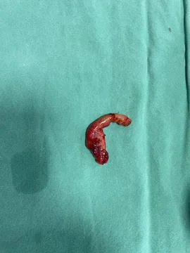 Inflamed Appendix Surgically Removed 库存照片