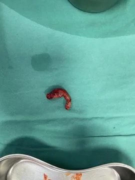 Inflamed Appendix Surgically Removed Stock Photos