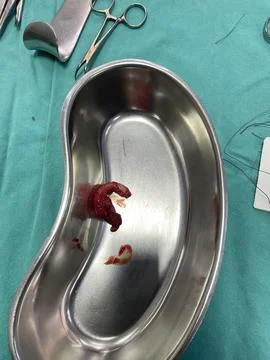 Inflamed Appendix Surgically Removed 库存照片