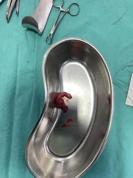 Inflamed Appendix Surgically Removed Stock Photos