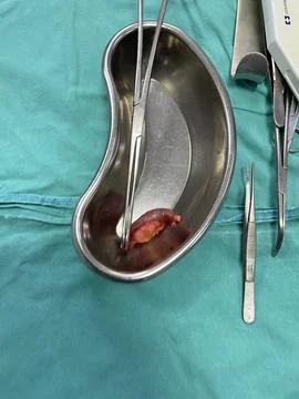 Inflamed Appendix Surgically Removed Foto stock