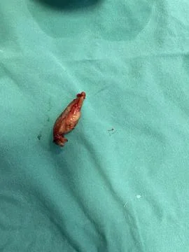 Inflamed Appendix Surgically Removed 库存照片