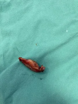 Inflamed Appendix Surgically Removed Stock Photos