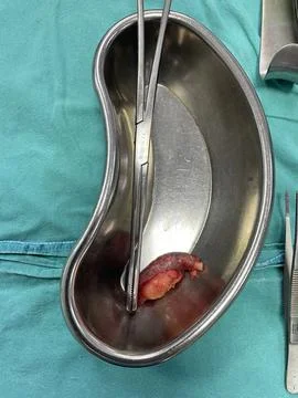 Inflamed Appendix Surgically Removed Stock Photos