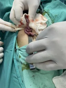Inflamed Appendix Surgically Removed Foto stock