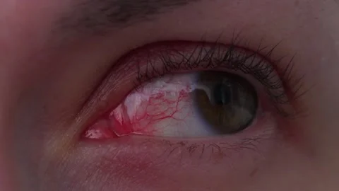 An inflamed eye Stock Footage 315688757