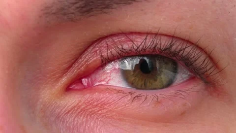 An inflamed eye Stock Footage 315689265