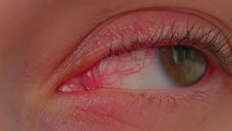 An inflamed eye Stock Footage 315689356