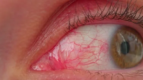 An inflamed eye Stock Footage 315689392
