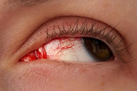 An inflamed eye Fotos Stock