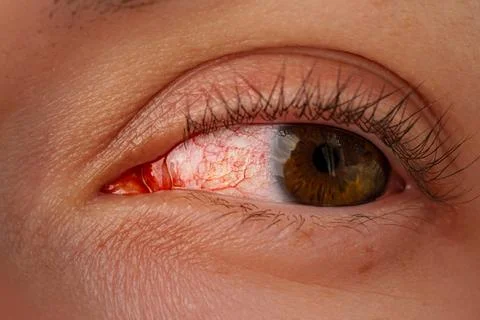 An inflamed eye Stock-Fotos