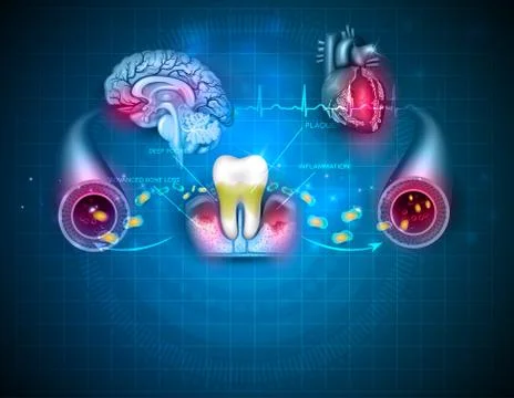 Inflamed gums bacteria Stock Illustration