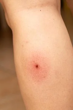 Inflamed tick bite causing redness and irritation on leg skin 스톡 사진