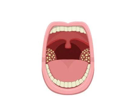 Inflamed Tonsillitis in vector design Stock Illustration